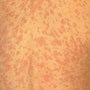Maine has first confirmed case of measles in 20 years